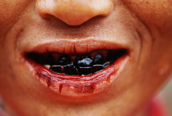 A Palung Hill tribeswoman teeth have turned black from chewing on betel nuts.